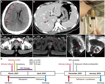 Genomic surveillance indicates clonal replacement of hypervirulent Klebsiella pneumoniae ST881 and ST29 lineage strains in vivo